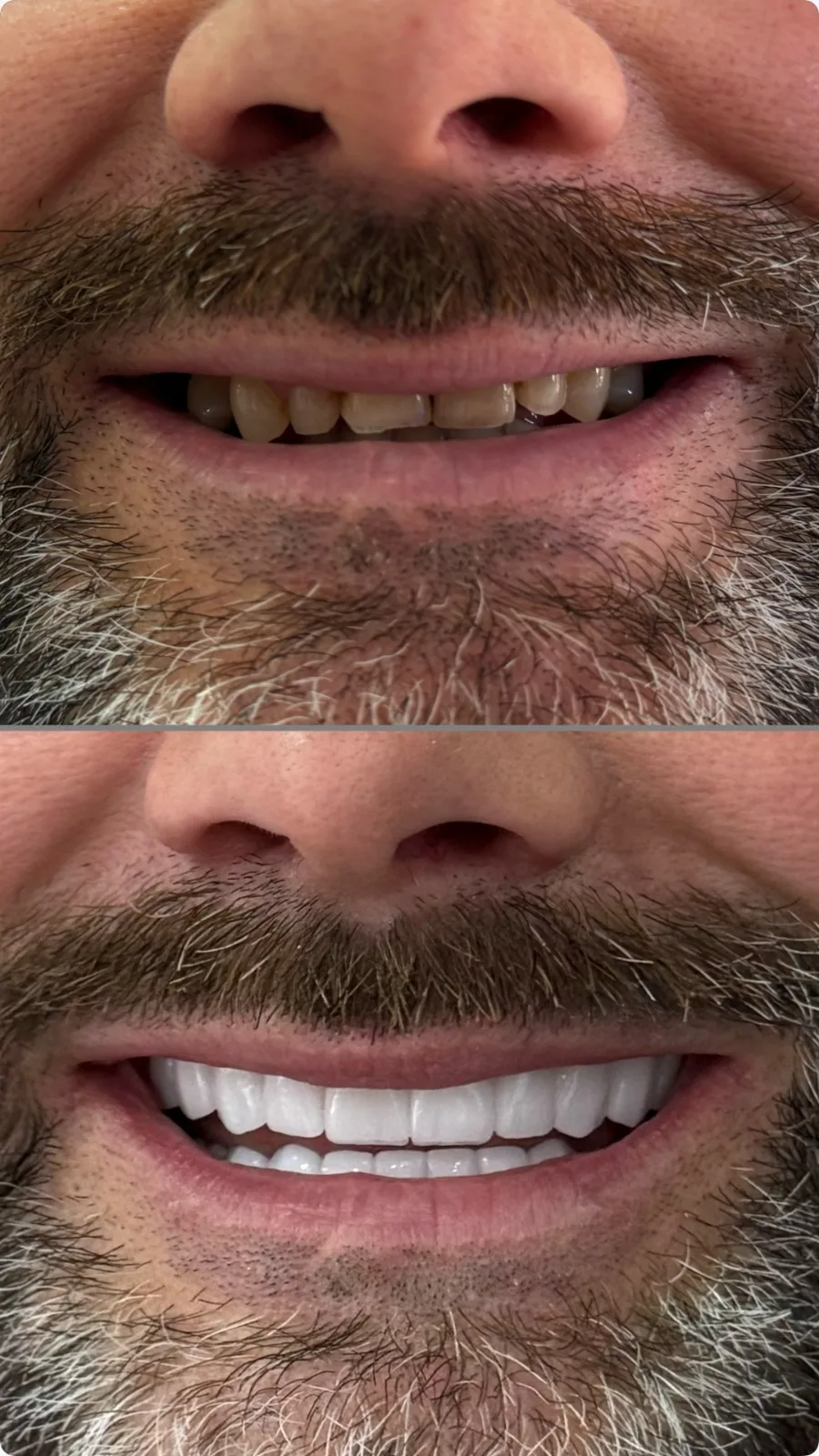 Vorher-Nachher Porzellan-Veneers, natürliches Lächeln