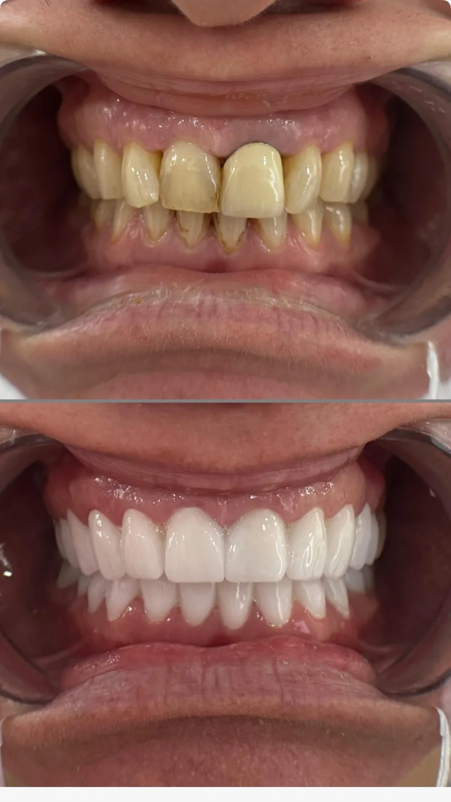 Vorher-Nachher Zahnaufhellung und Veneers kombiniert