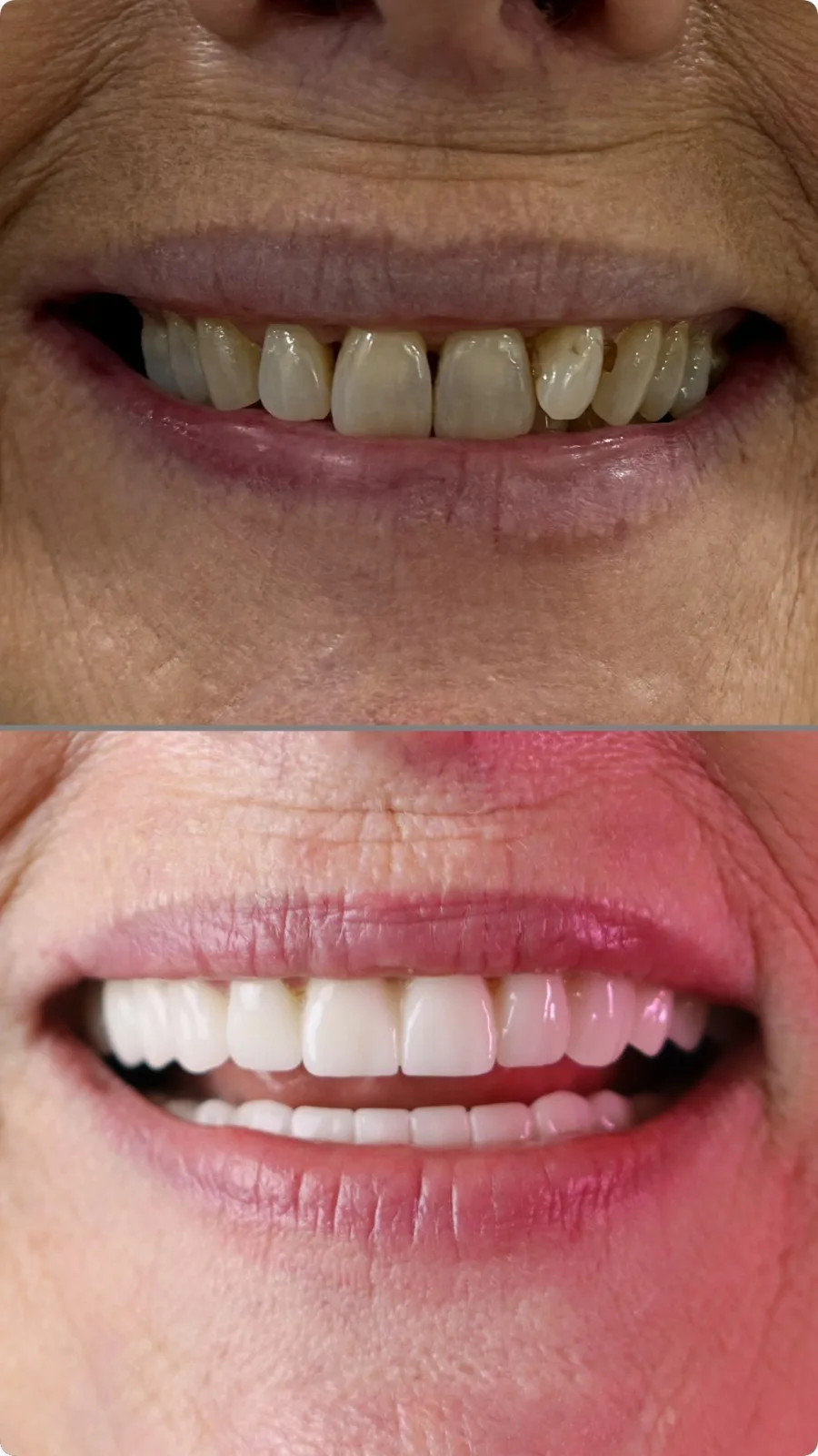 Vorher-Nachher Foto Implantat- und Veneerbehandlung im Oberkiefer